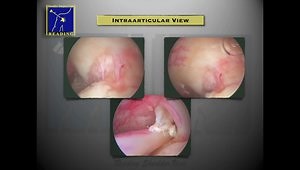 Arthroscopic Long Head of Biceps Tenodesis and Intratendinous Pasta Repair: The Way We Do It at the Reading Shoulder Unit.