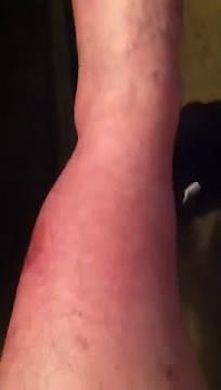 Dvt blood clot swelling