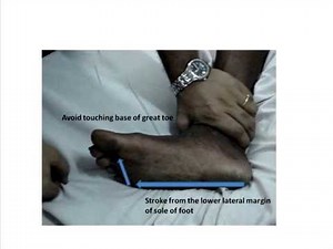 Plantar reflex- outline of methods