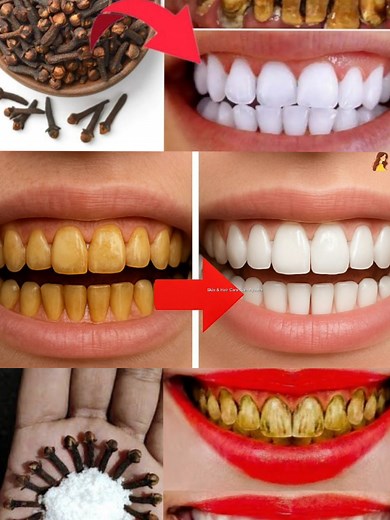 Effective DIY Teeth Whitening Remedies at Home