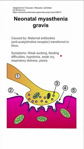 Neonatal myasthenia gravis