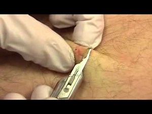 Shave Biopsy