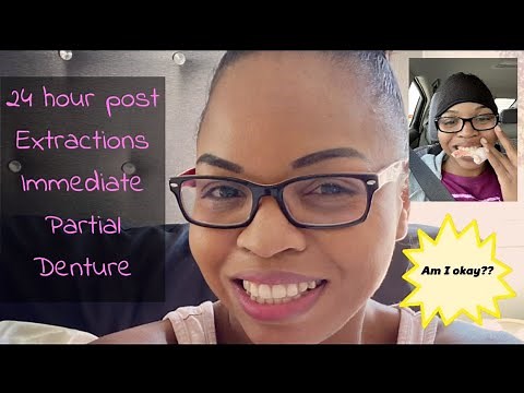 24 hours post extraction and immediate partial denture