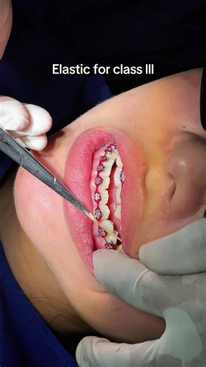 Understanding Elastic Bands for Class III Braces