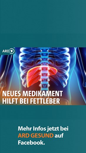 👉 www.ndr.de/fettleber102.html Ewald P. ist einer der ersten Betroffenen, die eine neuartige Behandlung bekommen - denn in der EU gibt es erstmals Hoffnung auf ein Medikament gegen Fettleber und Leberfibrose. Wie wirkt es und was sind die Risiken? | ARD GESUND