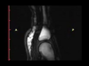 Real-time MRI of joint cracking