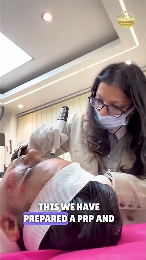 Acne Scars Explained: Microneedling Treatment Approach