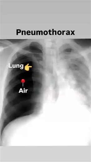 chest x ray abnormalities.. #roengton #radiopedia1895 #radiology