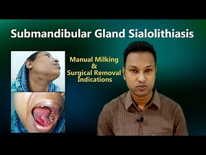 Salivary Gland Stone or Sialolith - Submandibular Gland Involvement & Management