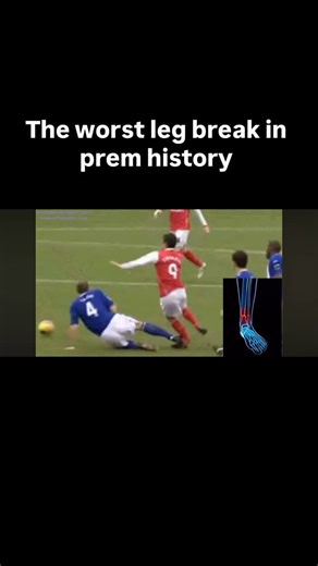 @rehabnovel on Instagram: "🚨 Injury Breakdown: Eduardo da Silva vs Birmingham City 🚨 Eduardo suffered a catastrophic open tibia and fibula fracture following a high-energy contact tackle. The injury occurred when his leg was planted and unable to rotate, while an external force was applied at speed. 🔬 Mechanism of injury: • Foot planted on the turf • Tackler’s force contacts the lower leg • Tibia experiences bending (valgus) + axial load • Bone tolerance exceeded → structural failure 🔬 Struc