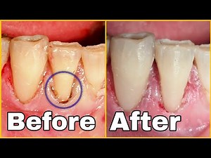 Class V composite restoration | How is composite filling procedure?| Dentist | asmr | satisfying