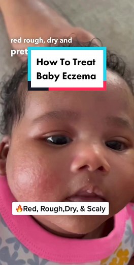 How to treat eczema in babies #eczema #eczemaawareness #babyrash #babyskincare #larocheposay #skintok #skincaretiktok #babyskincareproducts