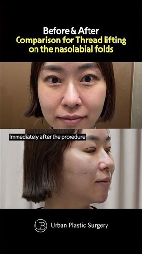 Before&After Thread lifting for nasolabial folds