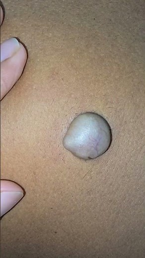 Back cyst treatment