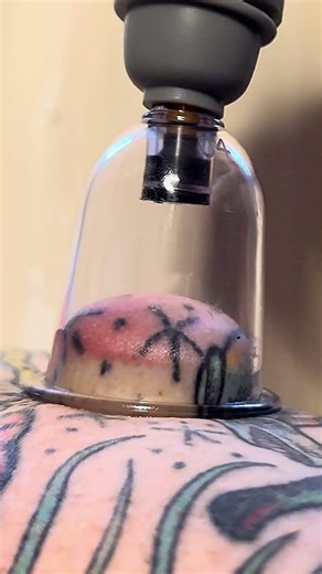 Cupping Therapy