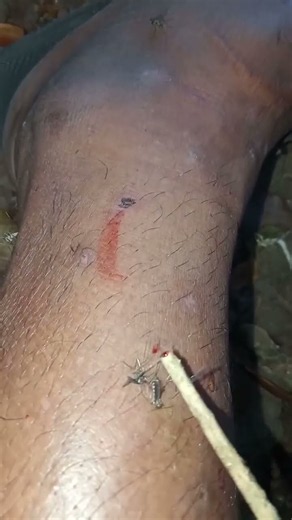 Why does this feel so good? Mosquito bite ASMR 🦟 #asmr