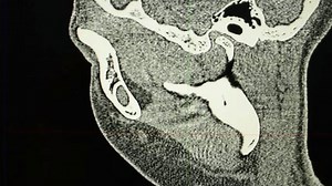 Paranasale bihuler, 3D CT-scanning MR-scanning Stock-video (100 % royaltyfri) 3683234579 | Shutterstock