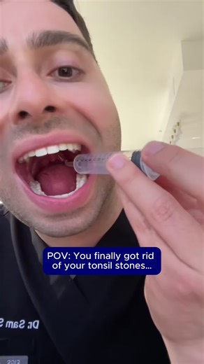 Understanding Tonsil Stones and Oral Health