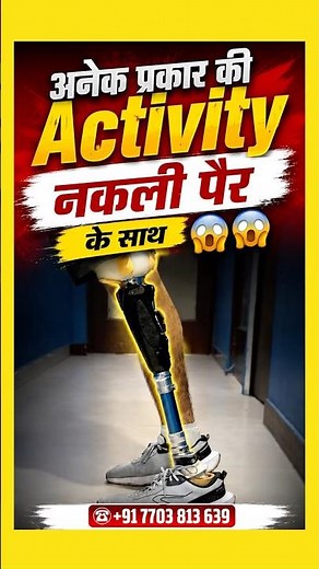 Activities With Above Knee Artificial Leg | #OSSUR #Naklitang #Aboveknee #artificiallimb