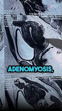 Why Most MRIs Fail to Detect Chronic Pelvic Pain? | Dr Jay Mehta, Mumbai