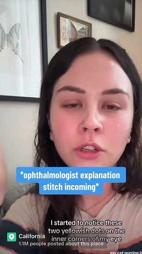 #stitch with @courtney 😎 Yes, wear good sun protection, but #pinguecula are very common. #sundamage #eyehealth #eyedoctortiktok #ophthalmologist