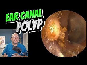 EAR CANAL POLYP! 399 #ear #earwax #earwaxremoval #asmr #satisfying #foryou #fyp #foryourpage