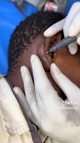 Effective Laser Treatment for Keloid Scars Management