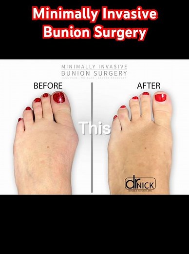 FUTRE OF BUNION SURGERY!