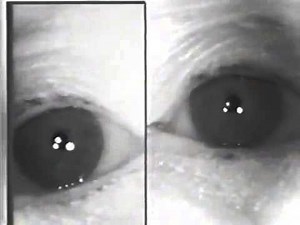 Argyll-Robertson Pupil: Light Near Dissociation