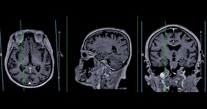 MRI Brain with reference line can help doctors look for conditions such as bleeding, swelling, tumors, infections, inflammation, damage from an injury or a stroke diseases.