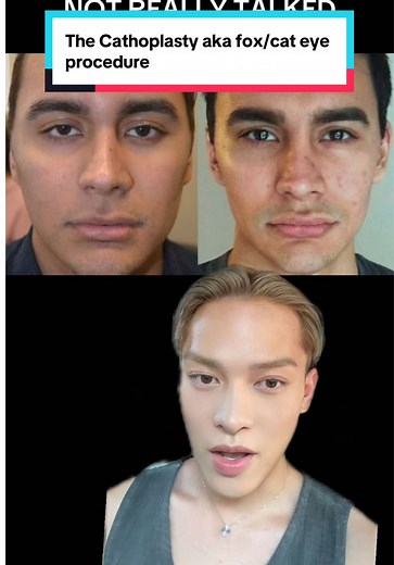 Understanding Canthoplasty: The Cat Eye Surgery Explained