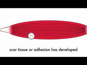 Active Release Techniques - Very Effective Treatment for Soft Tissue Injuries