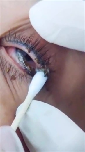 Semua Masalah Mata Bisa diatasi Dengan Vitamin ini #vitaminmata #kesehatanmata #tetesmata #sehatalami