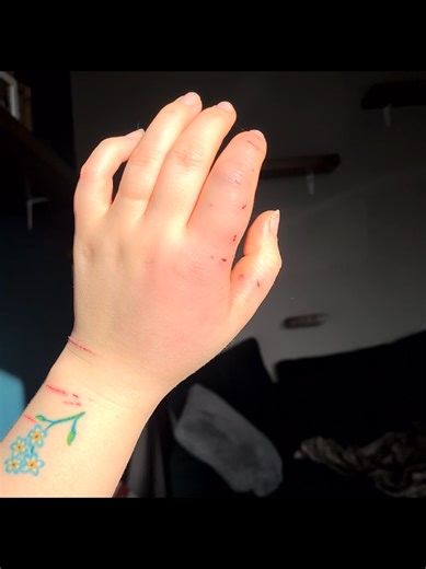 *This is an old video and wasn't Toby that did the biting* #catbite #catparent #rescuecat #specialneedscat