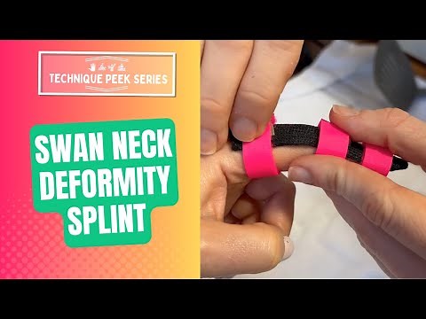 How to Create a Swan Neck Deformity Splint using Orficast | Technique Peek Series