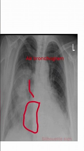 Chest x-ray: Key findings of lung Consolidation
