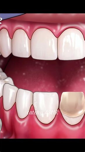 Dental treatment animation, Rotten teeth repair , ASMR animation, relaxing cavity filling treatment,
