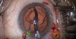 Light Adjustable Lens Removal - Eyetube