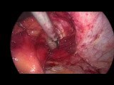 Laparoscopic Parastomal Hernia Repair by Modified Sugarbacker Technique • Video • MEDtube.net