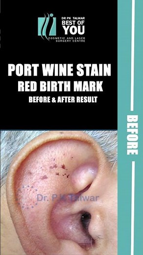 Red Birthmark क्या है | Port Wine Stain Treatment के Before & After Results | By Dr. PK Talwar