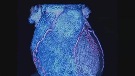 Cardiovascular disease is the leading cause of death in the U.S.