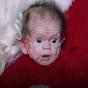 491K views · 5.3K reactions | Tinha a pele de um cachorro shar pei. Tomm Tennent era um bebê único na história da medicina. Ele nasceu com tanta pele que poderia cobrir uma criança de 5 anos. O porquê é desconhecido. Mas eles encontraram uma semelhança entre sua condição e a dos filhotes shar pei. Os especialistas nunca tinham visto algo semelhante e não sabiam como curar: a única solução seria esperar e ver as consequências após 10 anos. | Vitamina + | Facebook