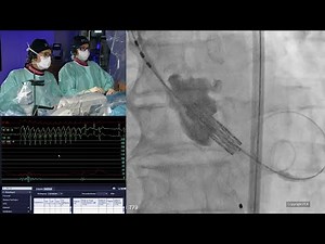 TAVI in 2025: transforming care with the new valvular heart disease guidelines - PCR London Valves