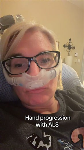 Mavsgram62 ALS affects all of its victims in unique or different ways. Onset symptoms, progression rates, and areas of the body that are impacted varying significantly from person to person. The variability in differing onsets (limb, bulbar, respiratory) means some people may experience muscle weakness in their limbs, while others might first encounter issues with speech or swallowing, and some may even have cognitive or behavioral changes before or alongside physical symptoms, some present with
