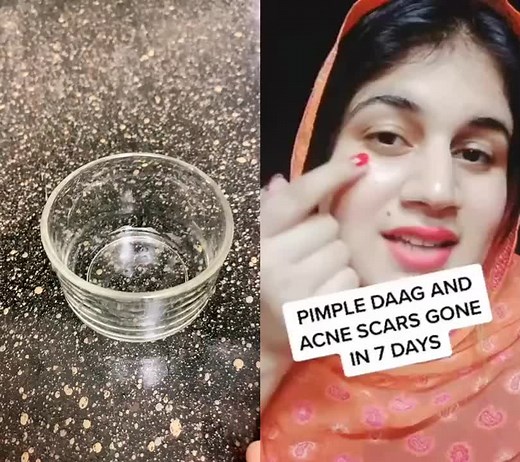 Easy Home Remedies for Acne Scar Removal | Face Mask Tutorial