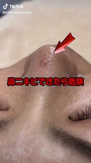 鼻ニキビができたら注意！原因とケア方法