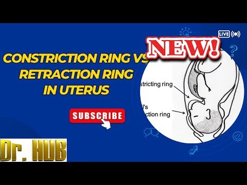 Constriction ring vs retraction ring in uterus