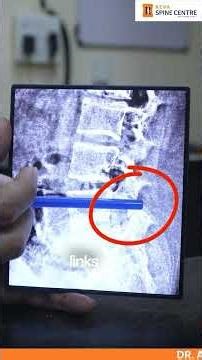 15-Year-Old Boy with Spine Problem–Back to Normal Within 12 Hours After Surgery! | Reva Spine Centre