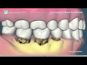 Formação da Bolsa Periodontal
