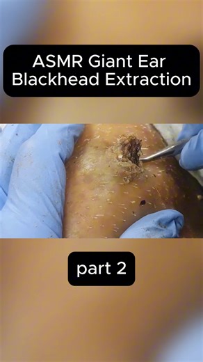 ASMR Giant Ear Blackhead Extraction | Dr. Pimple Popper’s Most Satisfying part 1. #dermatology #skin #abscess #mpzdermatology #tiktokusa🇺🇸